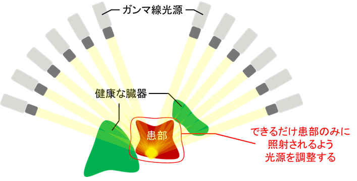 図1 ガンマナイフ治療計画のイメージ